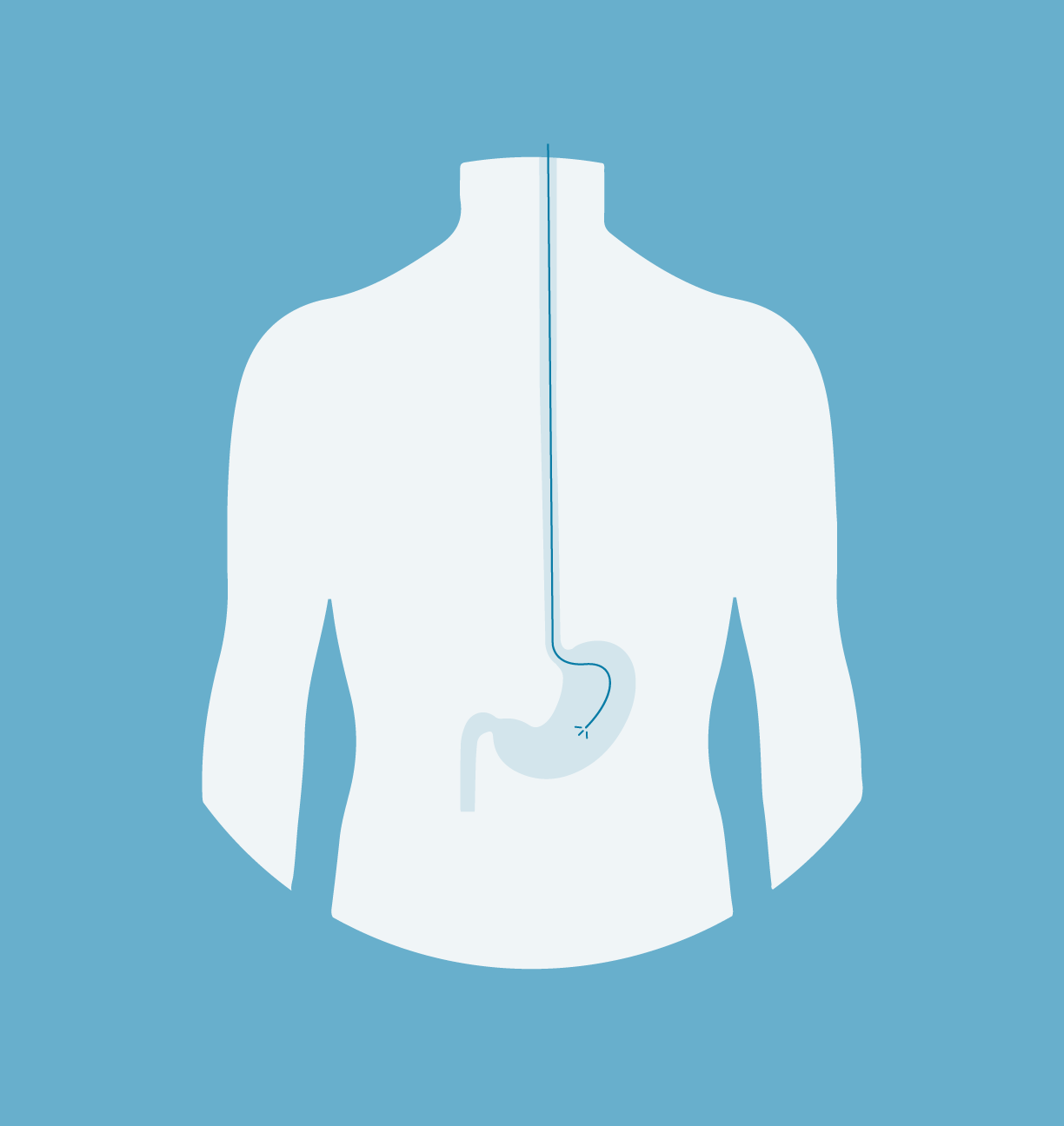 Gastro Oesophageal Reflux Disease GORD Nicholas Boyle parkash-badal-latest-news-on-infertility