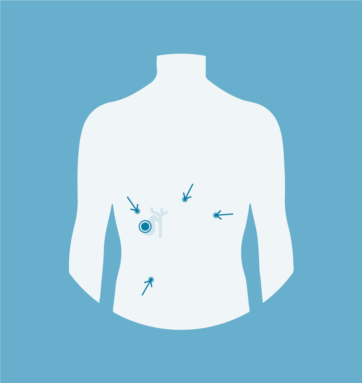 Laparoscopic Cholecystectomy - Nicholas Boyle